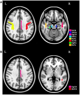 Identifying Depression in Parkinson's Disease by Using Combined Diffusion Tensor Imaging and Support Vector Machine